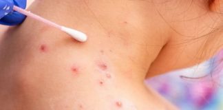Variola maimuta: Ce este, simptome, transmitere si multe altele